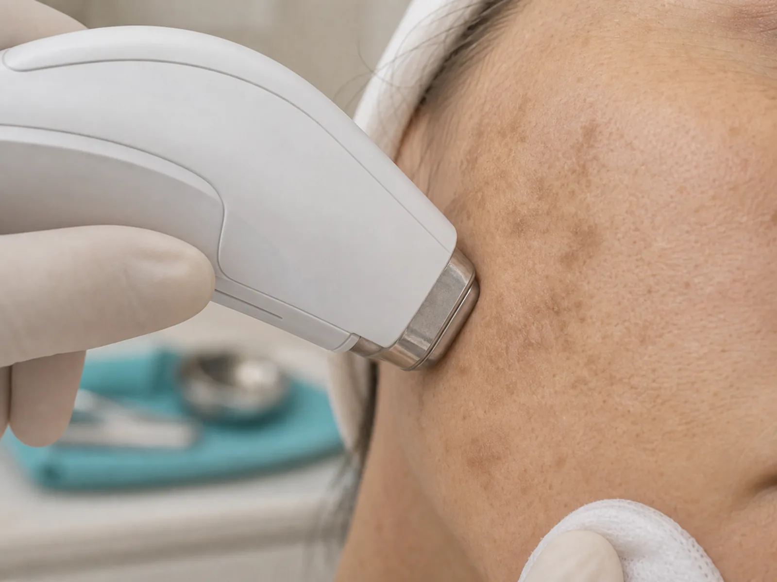 Pigment spots and hyperpigmentation - specialist consultation Laser treatment handpiece positioned near pigment spots for medical planning