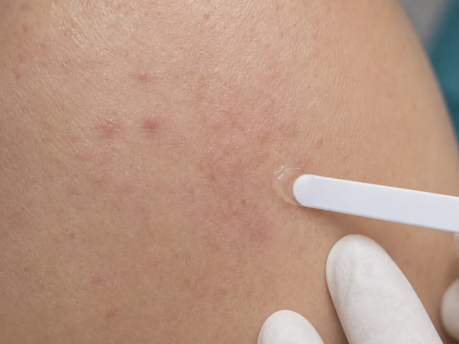 Control medic specialist dermatologie Aplicare de gel dermatologic pe urme post-acneice in cadrul controlului