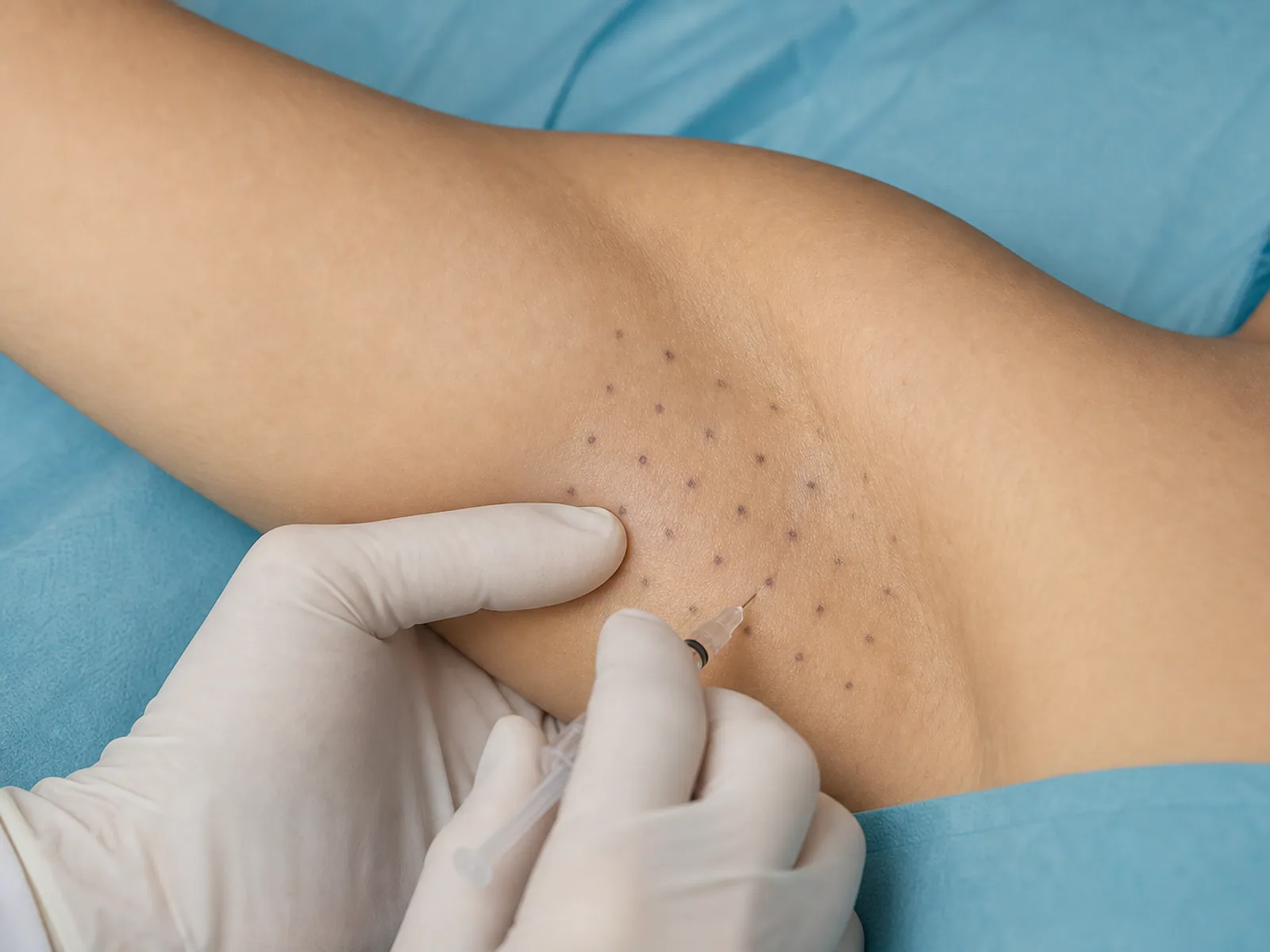 Tratament hiperhidroza axilara Tratament injectabil pentru hiperhidroza axilara pe zona marcata
